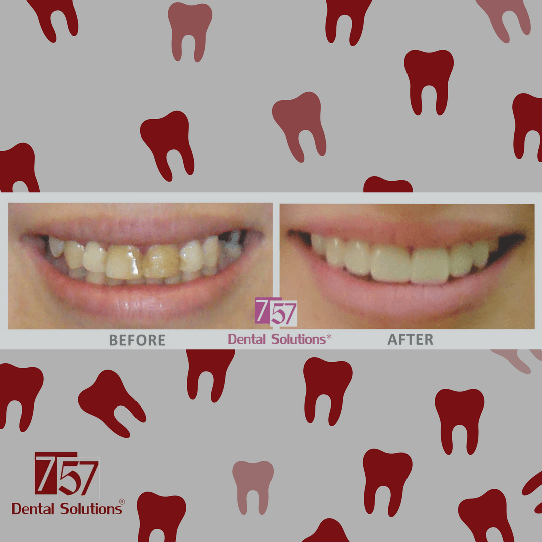 Before after fotos cosmetic dentistry