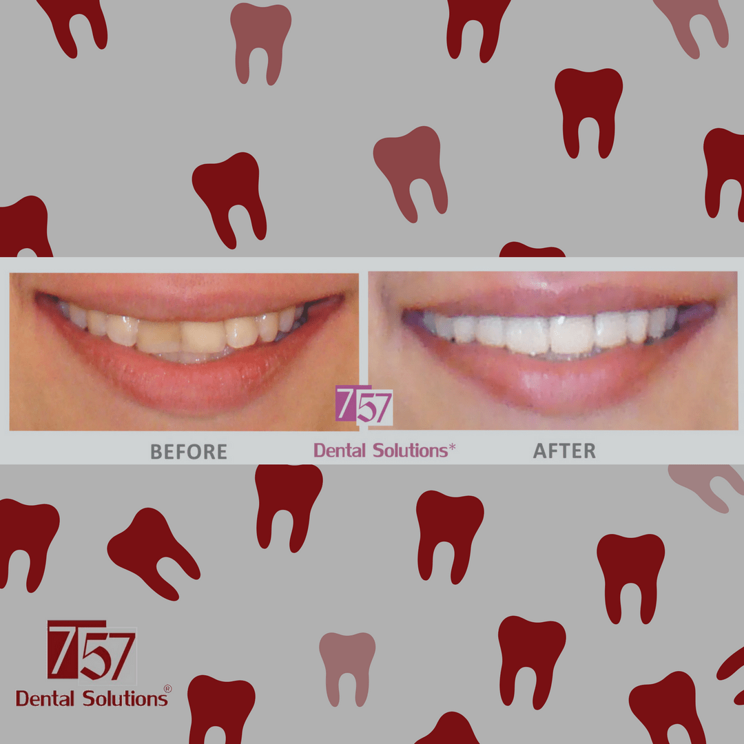Before after fotos cosmetic dentistry