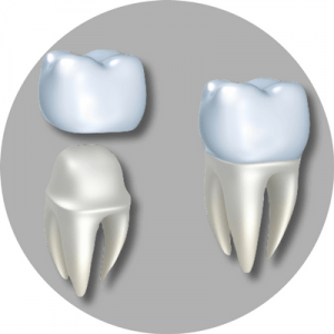 dental crowns