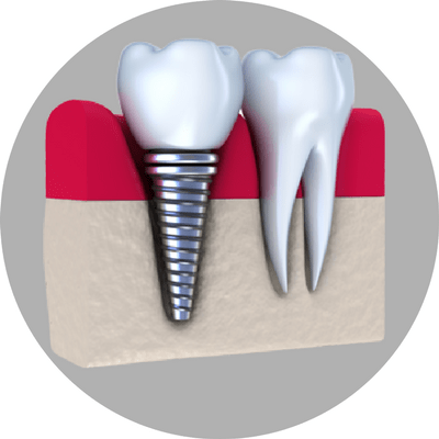 Mini Implantes Dentales