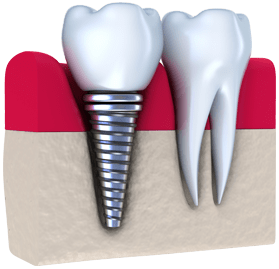 mexico dental implants